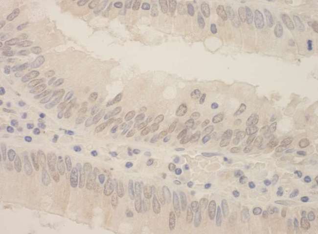 SRPK2 Antibody - Detection of Human SRPK2 by Immunohistochemistry. Sample: FFPE section of human colon carcinoma. Antibody: Affinity purified rabbit anti-SRPK2 used at a dilution of 1:250.