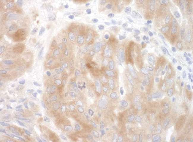 SRPK2 Antibody - Detection of Human SRPK2 by Immunohistochemistry. Sample: FFPE section of human ovarian carcinoma. Antibody: Affinity purified rabbit anti-SRPK2 used at a dilution of 1:200 (1 ug/ml). Detection: DAB.