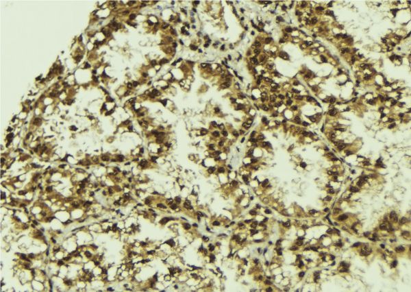 SRPK2 Antibody - 1:100 staining human lung tissue by IHC-P. The sample was formaldehyde fixed and a heat mediated antigen retrieval step in citrate buffer was performed. The sample was then blocked and incubated with the antibody for 1.5 hours at 22°C. An HRP conjugated goat anti-rabbit antibody was used as the secondary.