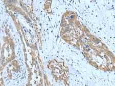SRPK2 Antibody - Immunohistochemistry of paraffin-embedded Human thyroid cancer tissue  using SRPK2 Polyclonal Antibody at dilution of 1:90(×200)