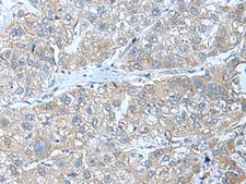 SRPK2 Antibody - Immunohistochemistry of paraffin-embedded Human liver cancer tissue  using SRPK2 Polyclonal Antibody at dilution of 1:55(×200)