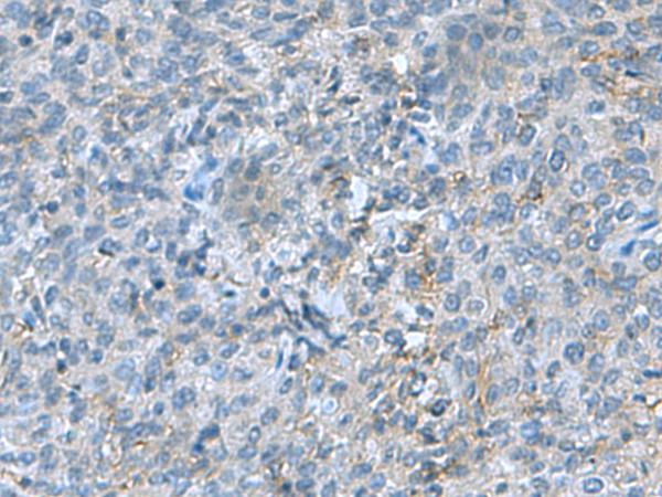 SRPK2 Antibody - Immunohistochemistry of paraffin-embedded Human cervical cancer tissue  using SRPK2 Polyclonal Antibody at dilution of 1:55(×200)