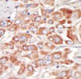 SRPK3 / MSSK1 Antibody - Formalin-fixed and paraffin-embedded human cancer tissue reacted with the primary antibody, which was peroxidase-conjugated to the secondary antibody, followed by DAB staining. This data demonstrates the use of this antibody for immunohistochemistry; clinical relevance has not been evaluated. BC = breast carcinoma; HC = hepatocarcinoma.