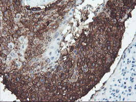 SRPRB Antibody - IHC of paraffin-embedded Carcinoma of Human lung tissue using anti-SRPRB mouse monoclonal antibody.