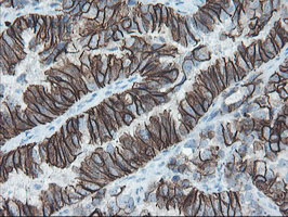SRPRB Antibody - IHC of paraffin-embedded Adenocarcinoma of Human ovary tissue using anti-SRPRB mouse monoclonal antibody.