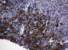 SRPRB Antibody - IHC of paraffin-embedded Adenocarcinoma of Human colon tissue using anti-SRPRB mouse monoclonal antibody. (Heat-induced epitope retrieval by 10mM citric buffer, pH6.0, 120°C for 3min).