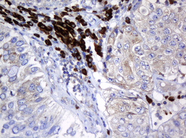 SRPRB Antibody - IHC of paraffin-embedded Carcinoma of Human bladder tissue using anti-SRPRB mouse monoclonal antibody. (Heat-induced epitope retrieval by 10mM citric buffer, pH6.0, 120°C for 3min).