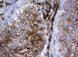 SRPRB Antibody - IHC of paraffin-embedded Adenocarcinoma of Human colon tissue using anti-SRPRB mouse monoclonal antibody.