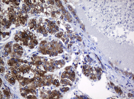 SRPRB Antibody - IHC of paraffin-embedded Carcinoma of Human liver tissue using anti-SRPRB mouse monoclonal antibody.