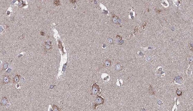 SRPX Antibody - 1:100 staining human brain carcinoma tissue by IHC-P. The sample was formaldehyde fixed and a heat mediated antigen retrieval step in citrate buffer was performed. The sample was then blocked and incubated with the antibody for 1.5 hours at 22°C. An HRP conjugated goat anti-rabbit antibody was used as the secondary.