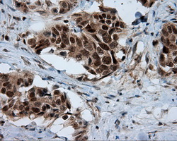 SRR / Serine Racemase Antibody - IHC of paraffin-embedded Adenocarcinoma of breast tissue using anti-SRR mouse monoclonal antibody. (Dilution 1:50).