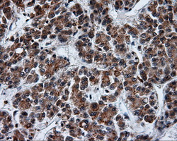 SRR / Serine Racemase Antibody - IHC of paraffin-embedded Carcinoma of liver tissue using anti-SRR mouse monoclonal antibody. (Dilution 1:50).