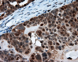 SRR / Serine Racemase Antibody - IHC of paraffin-embedded Adenocarcinoma of ovary tissue using anti-SRR mouse monoclonal antibody. (Dilution 1:50).