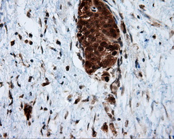 SRR / Serine Racemase Antibody - IHC of paraffin-embedded Carcinoma of pancreas tissue using anti-SRR mouse monoclonal antibody. (Dilution 1:50).