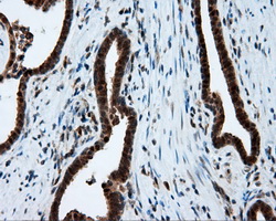 SRR / Serine Racemase Antibody - IHC of paraffin-embedded Carcinoma of prostate tissue using anti-SRR mouse monoclonal antibody. (Dilution 1:50).
