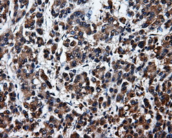 SRR / Serine Racemase Antibody - IHC of paraffin-embedded Carcinoma of liver tissue using anti-SRR mouse monoclonal antibody. (Dilution 1:50).