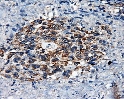 SRR / Serine Racemase Antibody - IHC of paraffin-embedded Carcinoma of bladder tissue using anti-SRR mouse monoclonal antibody. (Dilution 1:50).