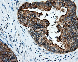SRR / Serine Racemase Antibody - IHC of paraffin-embedded Adenocarcinoma of colon tissue using anti-SRR mouse monoclonal antibody. (Dilution 1:50).