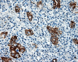 SRR / Serine Racemase Antibody - IHC of paraffin-embedded Carcinoma of thyroid tissue using anti-SRR mouse monoclonal antibody. (Dilution 1:50).