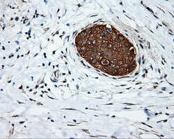 SRR / Serine Racemase Antibody - IHC of paraffin-embedded Carcinoma of pancreas tissue using anti-SRR mouse monoclonal antibody. (Dilution 1:50).
