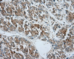 SRR / Serine Racemase Antibody - Immunohistochemical staining of paraffin-embedded Carcinoma of liver tissue using anti-SRR mouse monoclonal antibody. (Dilution 1:50).