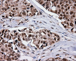 SRR / Serine Racemase Antibody - Immunohistochemical staining of paraffin-embedded Adenocarcinoma of breast tissue using anti-SRR mouse monoclonal antibody. (Dilution 1:50).