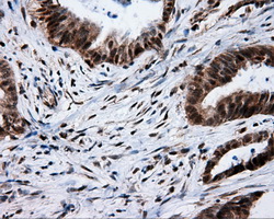 SRR / Serine Racemase Antibody - Immunohistochemical staining of paraffin-embedded Adenocarcinoma of colon tissue using anti-SRR mouse monoclonal antibody. (Dilution 1:50).