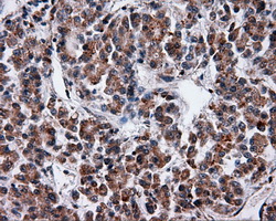 SRR / Serine Racemase Antibody - Immunohistochemical staining of paraffin-embedded Carcinoma of liver tissue using anti-SRR mouse monoclonal antibody. (Dilution 1:50).