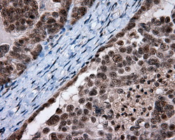 SRR / Serine Racemase Antibody - Immunohistochemical staining of paraffin-embedded Adenocarcinoma of ovary tissue using anti-SRR mouse monoclonal antibody. (Dilution 1:50).