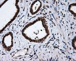 SRR / Serine Racemase Antibody - Immunohistochemical staining of paraffin-embedded Carcinoma of prostate tissue using anti-SRR mouse monoclonal antibody. (Dilution 1:50).