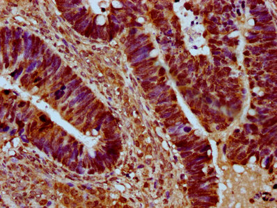 SRRM4 Antibody - Immunohistochemistry Dilution at 1:500 and staining in paraffin-embedded human ovarian cancer performed on a Leica BondTM system. After dewaxing and hydration, antigen retrieval was mediated by high pressure in a citrate buffer (pH 6.0). Section was blocked with 10% normal Goat serum 30min at RT. Then primary antibody (1% BSA) was incubated at 4°C overnight. The primary is detected by a biotinylated Secondary antibody and visualized using an HRP conjugated SP system.
