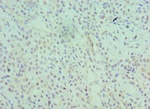 SRSF1 / SF2 Antibody - Immunohistochemistry of paraffin-embedded human breast cancer using antibody at 1:100 dilution.