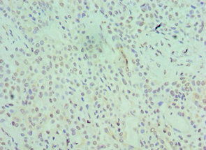 SRSF1 / SF2 Antibody - Immunohistochemistry of paraffin-embedded human breast cancer using SRSF1 Antibody at dilution of 1:100