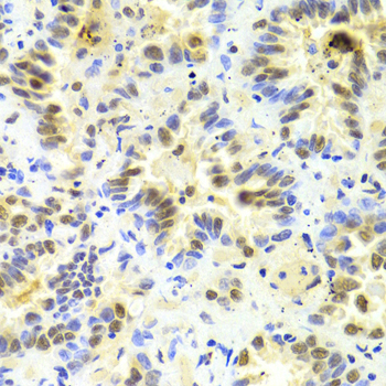 SRSF1 / SF2 Antibody - Immunohistochemistry of paraffin-embedded human lung cancer using SRSF1 Antibodyat dilution of 1:100 (40x lens).
