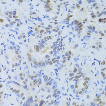 SRSF1 / SF2 Antibody - Immunohistochemistry of paraffin-embedded human lung cancer using SRSF1 Antibodyat dilution of 1:200 (40x lens).