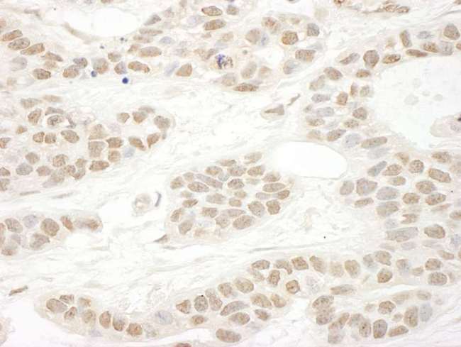 SRSF10 / FUSIP1 Antibody - Detection of Human FUSIP1 by Immunohistochemistry. Sample: FFPE section of human breast carcinoma. Antibody: Affinity purified rabbit anti-FUSIP1 used at a dilution of 1:250.