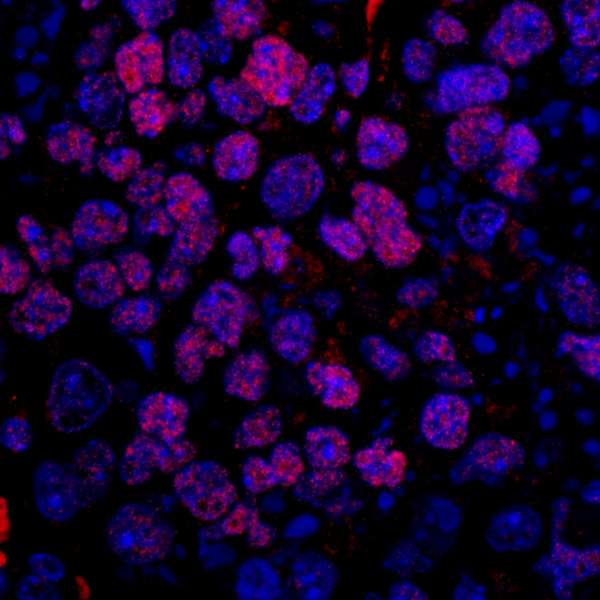 SRSF10 / FUSIP1 Antibody - Detection of Human FUSIP1 by Immunohistochemistry. Sample: FFPE section of human breast carcinoma. Antibody: Affinity purified rabbit anti-FUSIP1 used at a dilution of 1:100. Detection: Red-fluorescent Goat anti-Rabbit IgG-heavy and light chain cross-adsorbed Antibody DyLight 594 Conjugated (A120-601D4) used at a dilution of 1:100.