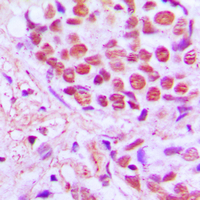 SRSF4 / SFRS4 Antibody - Immunohistochemical analysis of SRSF4 staining in human breast cancer formalin fixed paraffin embedded tissue section. The section was pre-treated using heat mediated antigen retrieval with sodium citrate buffer (pH 6.0). The section was then incubated with the antibody at room temperature and detected using an HRP conjugated compact polymer system. DAB was used as the chromogen. The section was then counterstained with hematoxylin and mounted with DPX.