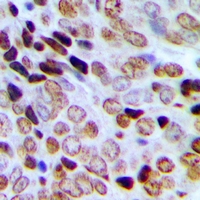 SRSF8 Antibody - Immunohistochemical analysis of SRSF8 staining in human prostate cancer formalin fixed paraffin embedded tissue section. The section was pre-treated using heat mediated antigen retrieval with sodium citrate buffer (pH 6.0). The section was then incubated with the antibody at room temperature and detected with HRP and DAB as chromogen. The section was then counterstained with hematoxylin and mounted with DPX.