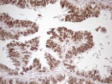 SRSF9 / SFRS9 Antibody - Immunohistochemical staining of paraffin-embedded Adenocarcinoma of Human ovary tissue using anti-SRSF9 mouse monoclonal antibody. (Heat-induced epitope retrieval by 1mM EDTA in 10mM Tris buffer. (pH8.5) at 120 oC for 3 min. (1:150)