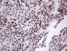 SRSF9 / SFRS9 Antibody - IHC of paraffin-embedded Adenocarcinoma of Human breast tissue using anti-SRSF9 mouse monoclonal antibody. (Heat-induced epitope retrieval by Tris-EDTA, pH8.0)(1:150).
