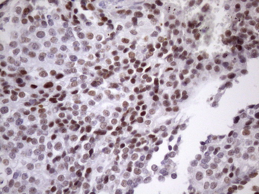 SRSF9 / SFRS9 Antibody - IHC of paraffin-embedded Adenocarcinoma of Human breast tissue using anti-SRSF9 mouse monoclonal antibody. (Heat-induced epitope retrieval by Tris-EDTA, pH8.0)(1:150).