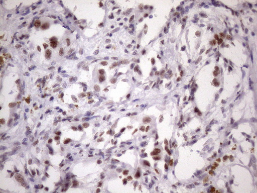 SRSF9 / SFRS9 Antibody - IHC of paraffin-embedded Carcinoma of Human kidney tissue using anti-SRSF9 mouse monoclonal antibody. (Heat-induced epitope retrieval by Tris-EDTA, pH8.0)(1:150).