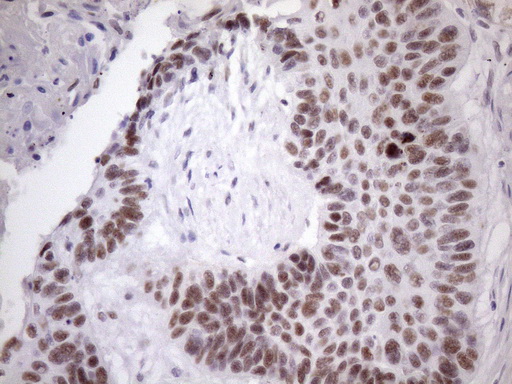 SRSF9 / SFRS9 Antibody - IHC of paraffin-embedded Carcinoma of Human lung tissue using anti-SRSF9 mouse monoclonal antibody. (Heat-induced epitope retrieval by Tris-EDTA, pH8.0)(1:150).