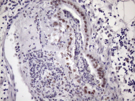SRSF9 / SFRS9 Antibody - IHC of paraffin-embedded Carcinoma of Human pancreas tissue using anti-SRSF9 mouse monoclonal antibody. (Heat-induced epitope retrieval by Tris-EDTA, pH8.0)(1:150).