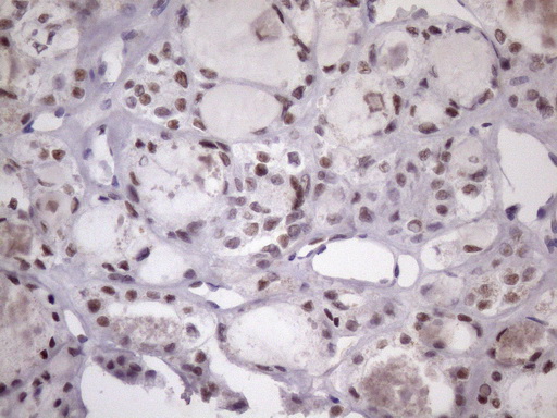 SRSF9 / SFRS9 Antibody - IHC of paraffin-embedded Carcinoma of Human thyroid tissue using anti-SRSF9 mouse monoclonal antibody. (Heat-induced epitope retrieval by Tris-EDTA, pH8.0)(1:150).
