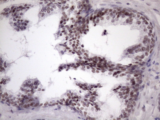 SRSF9 / SFRS9 Antibody - IHC of paraffin-embedded Carcinoma of Human prostate tissue using anti-SRSF9 mouse monoclonal antibody. (Heat-induced epitope retrieval by Tris-EDTA, pH8.0)(1:150).