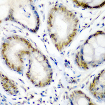 SS18 Antibody - Immunohistochemistry of paraffin-embedded human colon carcinoma tissue.