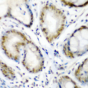 SS18 Antibody - Immunohistochemistry of paraffin-embedded human colon carcinoma tissue.