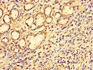SS18L1 / CREST Antibody - Immunohistochemistry of paraffin-embedded human gastric cancer at dilution of 1:100